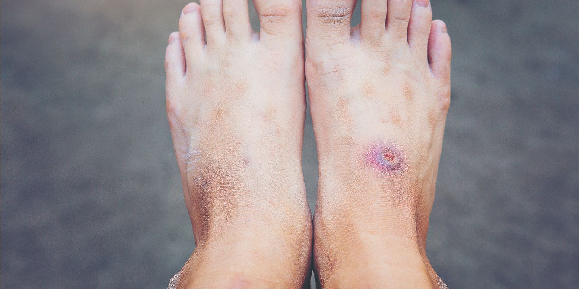 diabetic foot-web